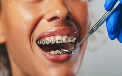 How Do Braces Work? A Complete Guide for Detroit Families