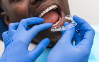 How Long Does Invisalign Take? Understanding Your Smile Timeline