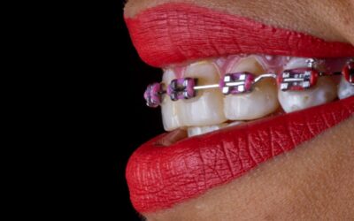 Braces vs Aligners: What’s Best for You or Your Child in Detroit?