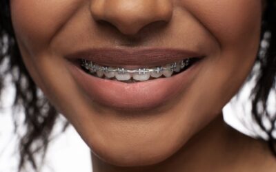 Invisalign vs. Braces: Which is Right for You?