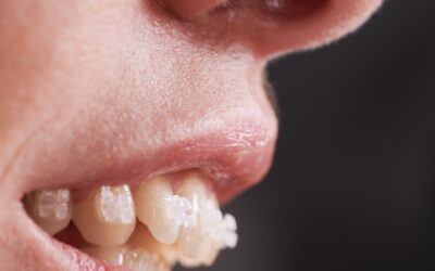 Is My Overbite or Underbite Bad Enough to Fix?