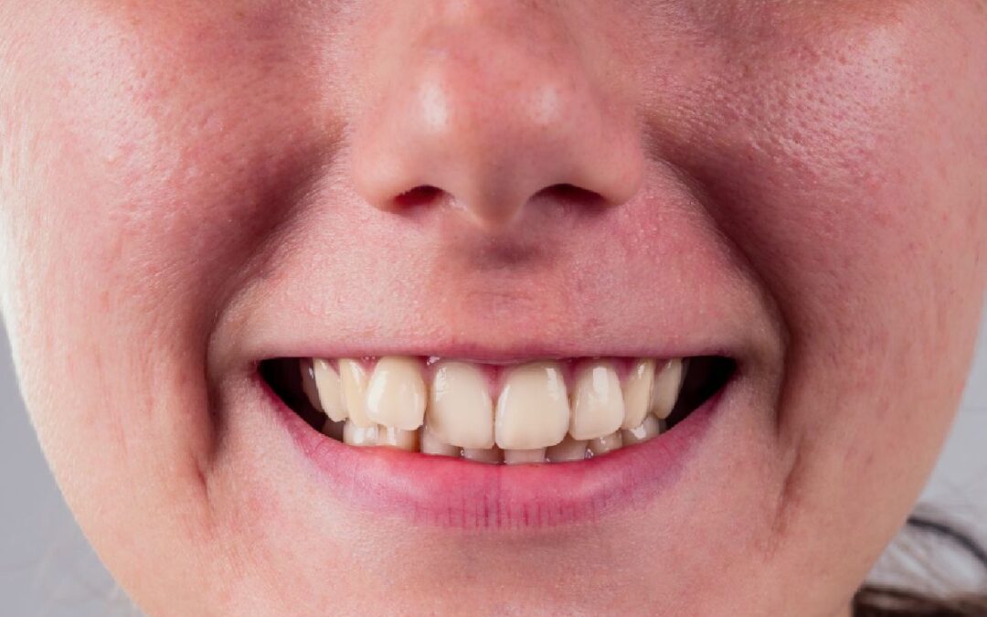 Can Crooked Teeth Cause Health Problems?