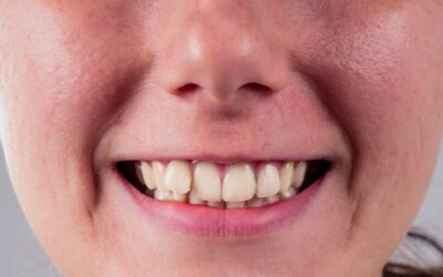 Can Crooked Teeth Cause Health Problems?